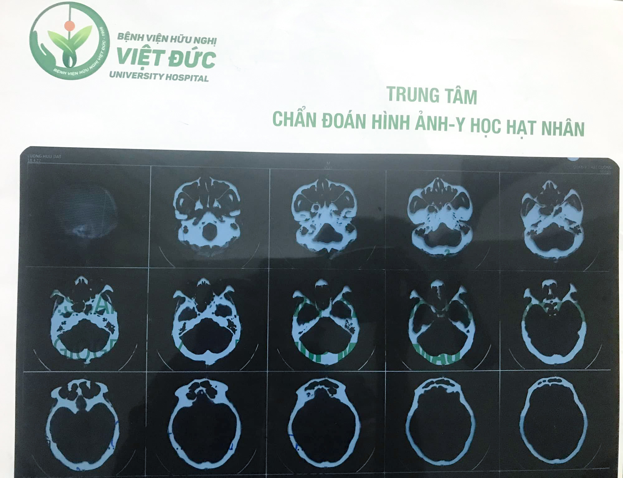 Kết quả chụp X quang của anh Lương Hữu Đạt tại bệnh viện Hữu nghị Việt - Đức cho thấy máu đã ngừng chảy, chỉ còn máu tụ, các miệng chảy đã thu nhỏ lại (ảnh do Phật tử cung cấp)