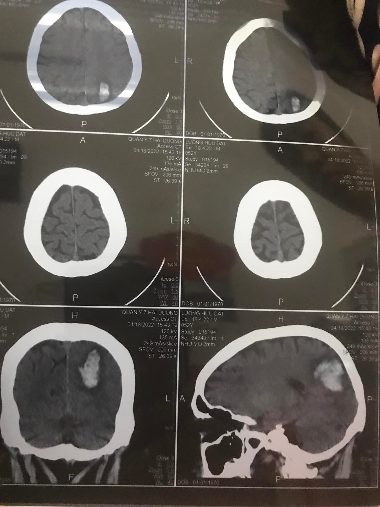 Hình ảnh chụp X quang sọ não của anh Lương Hữu Đạt lúc mới nhập viện Quân Y 7 - Hải Dương (hình ảnh do Phật tử cung cấp)