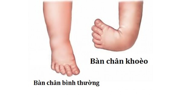 Bị khoèo chân từ lúc sơ sinh là loại bệnh do nghiệp báo (ảnh minh họa)