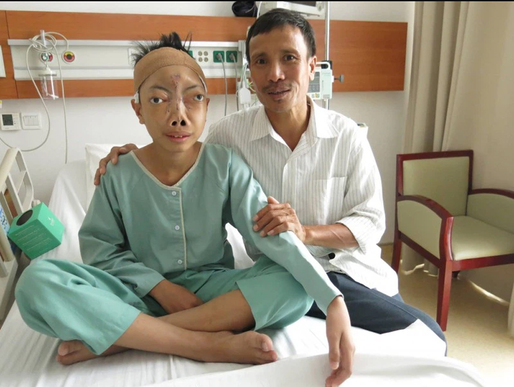 Khuôn mặt cậu bé Lê Trung Tuấn sau khi được phẫu thuật thành công (Nguồn ảnh: Internet)