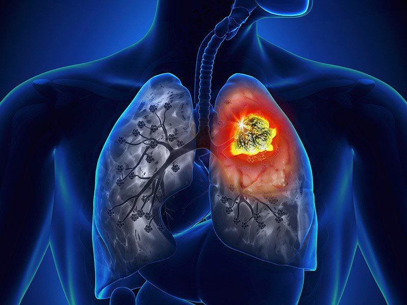 Một khối u trong lá phổi của con người (ảnh minh họa: ung thư phổi)